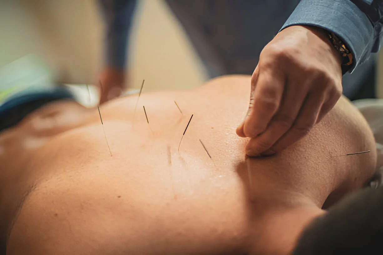 Therapeutic acupunture treatment for pain relief and wellness